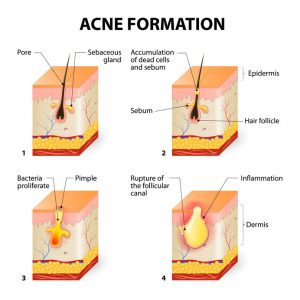 Acne formation